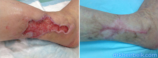 Трофические язвы