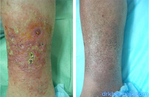 Трофические язвы