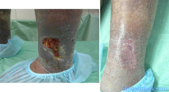 Трофические язвы