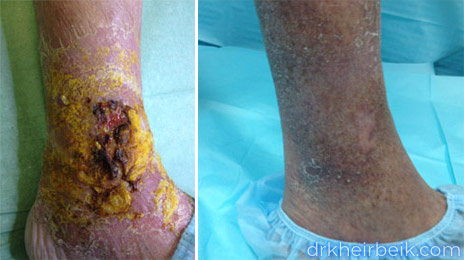 Трофические язвы