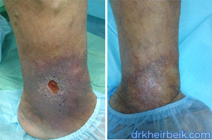 Трофические язвы