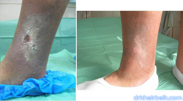 Трофические язвы