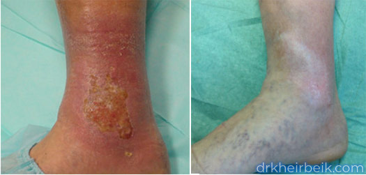 Трофические язвы