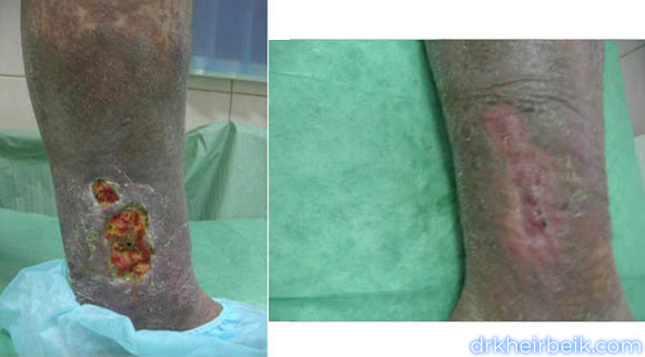 Трофические язвы