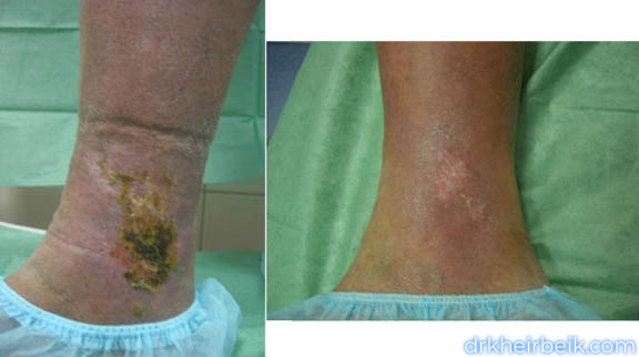 Трофические язвы