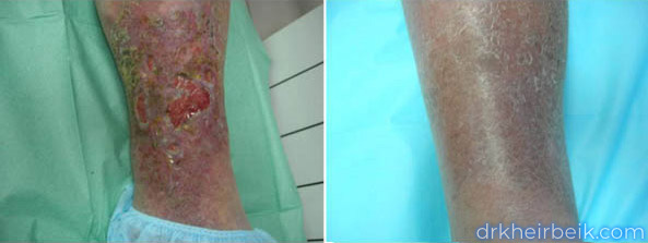 Трофические язвы