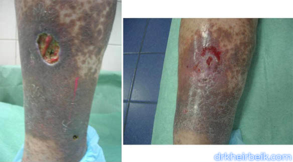 Трофические язвы