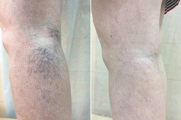 Варикоз нижних конечностей (Часть 2)