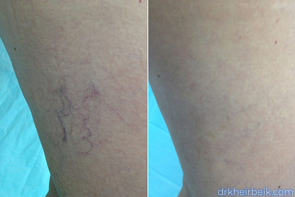 Варикоз нижних конечностей (Часть 2)