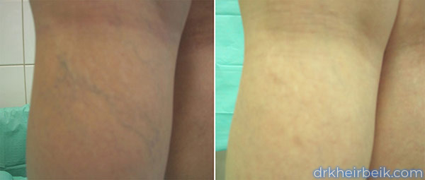 Варикоз нижних конечностей (Часть 2)