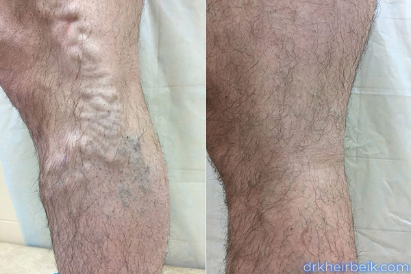 Варикоз нижних конечностей (Часть 2)