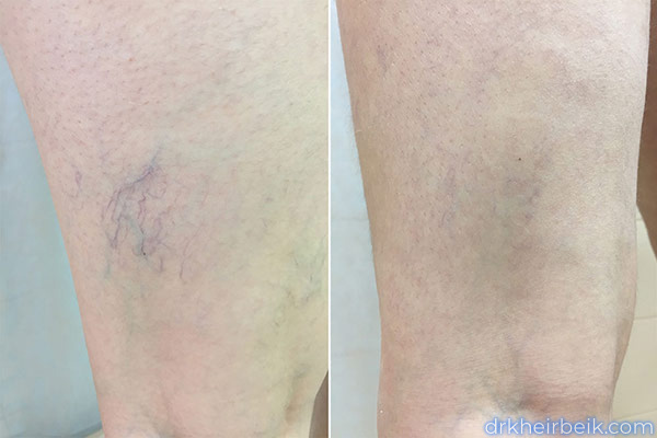 Варикоз нижних конечностей (Часть 2)