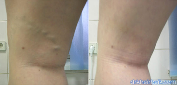 Варикоз нижних конечностей (Часть 2)