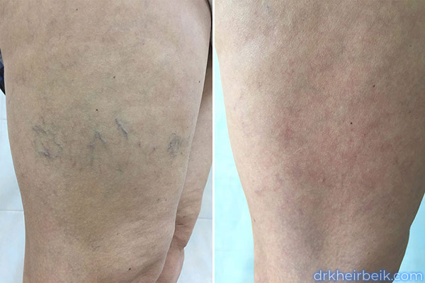 Варикоз нижних конечностей (Часть 2)