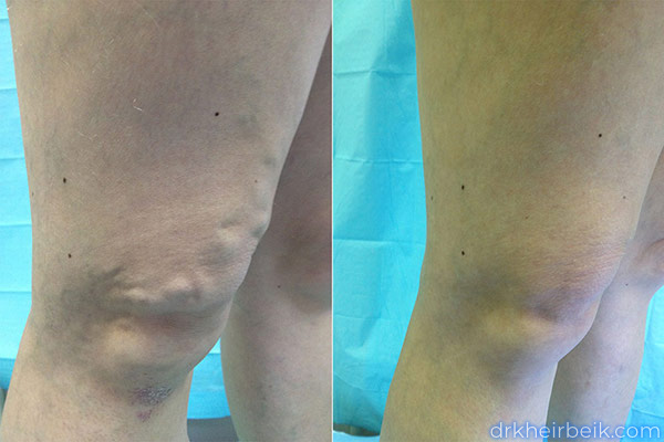 Варикоз нижних конечностей (Часть 2)