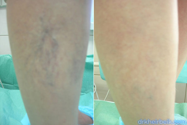 Варикоз нижних конечностей (Часть 2)