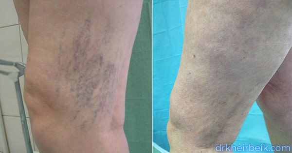 Варикоз нижних конечностей (Часть 2)