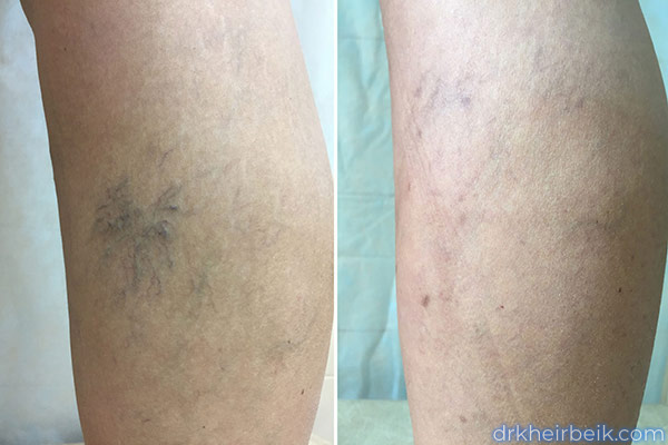 Варикоз нижних конечностей (Часть 2)