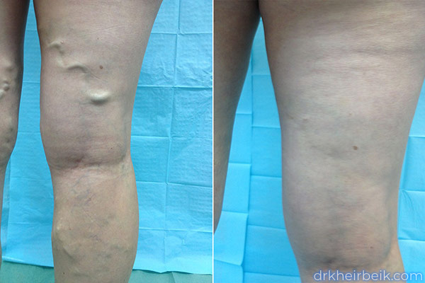 Варикоз нижних конечностей (Часть 1)