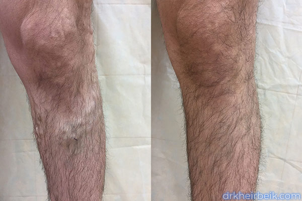 Варикоз нижних конечностей (Часть 1)