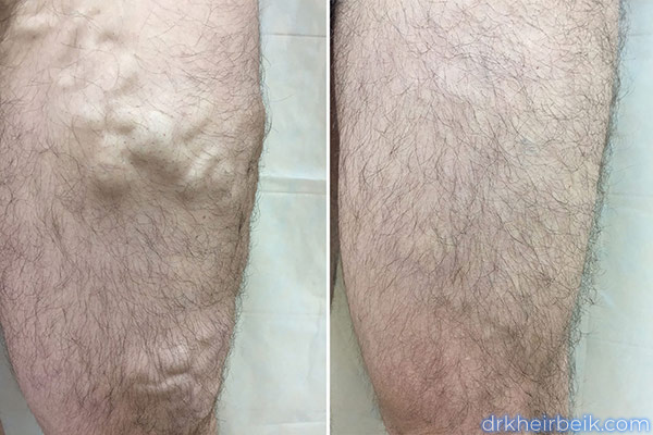 Варикоз нижних конечностей (Часть 1)