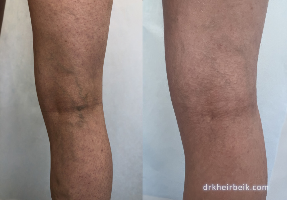 Варикоз нижних конечностей (Часть 3)