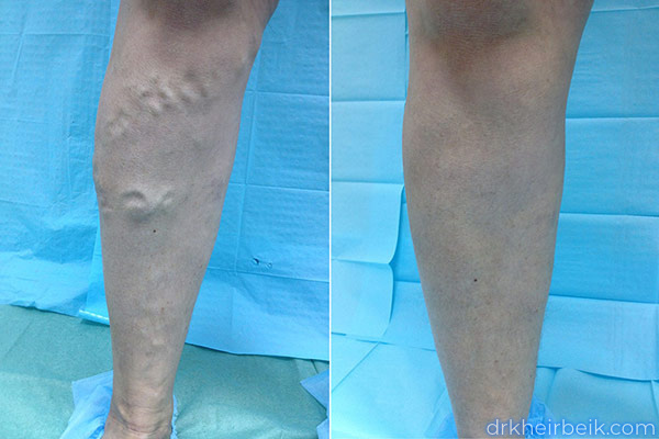 Варикоз нижних конечностей (Часть 1)