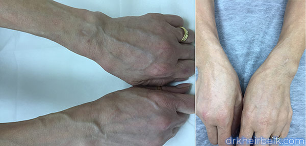 Варикоз рук