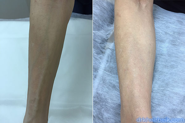 Варикоз рук