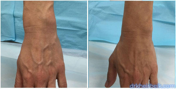 Варикоз рук