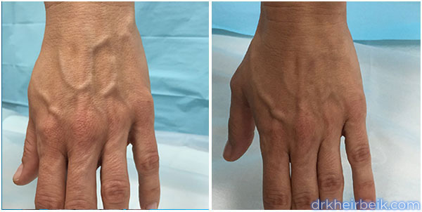 Варикоз рук