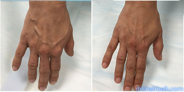 Варикоз рук