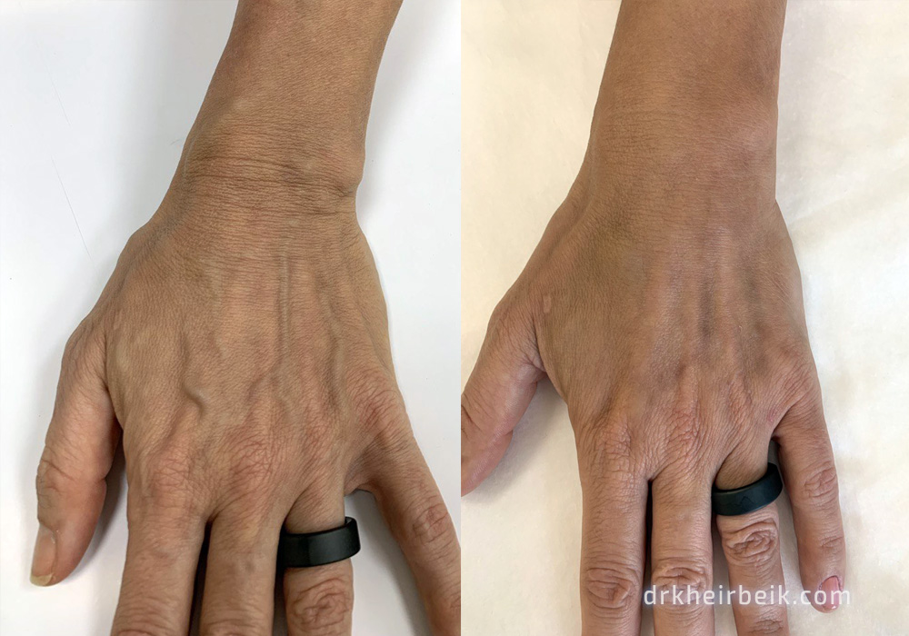 Варикоз рук