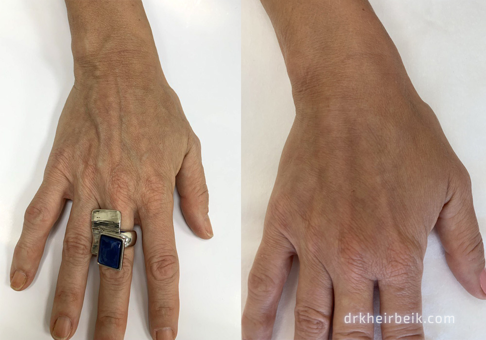 Варикоз рук